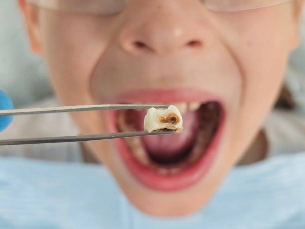 Best Knocked-Out Tooth (Avulsed Tooth) Treatment in East Hampton North, NY